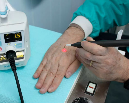 Tulio para láseres quirúrgicos